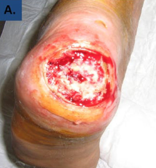Revaskularizacija stopala lahko ni dovolj za zacelitev rane